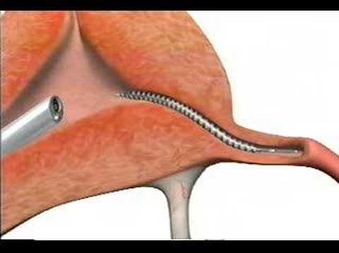 Essure Injury Cases